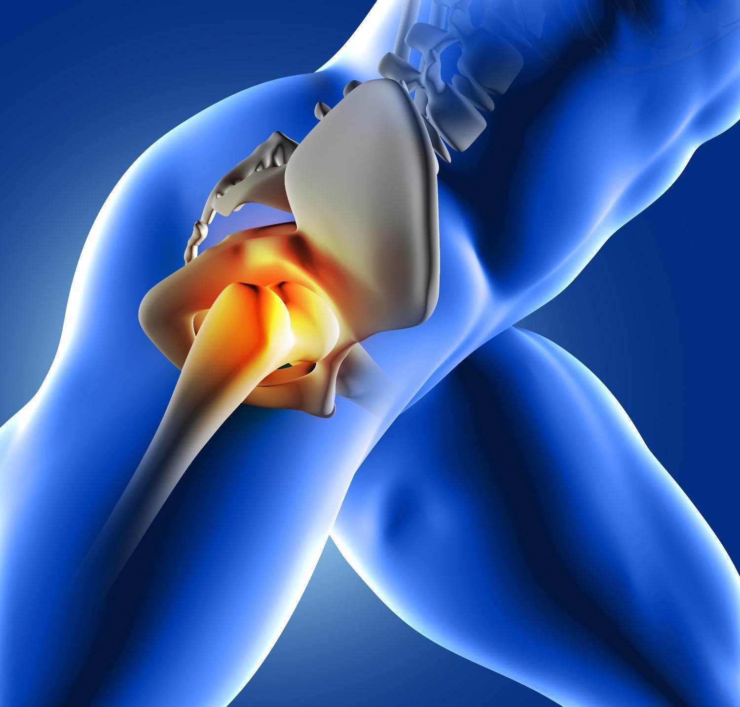 Hip Replacement Surgery in South Delhi