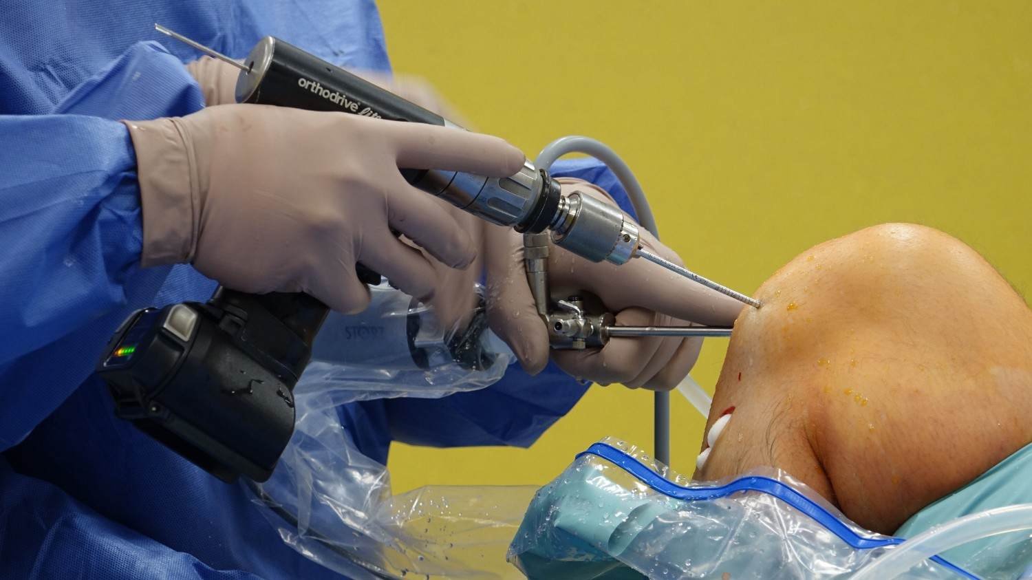 Total Knee Replacement Surgery in Gurugram