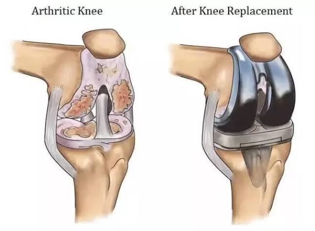 Knee Replacement
